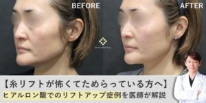 【糸リフトが怖くてためらっている方へ】ヒアルロン酸でのリフトアップ症例を医師が解説