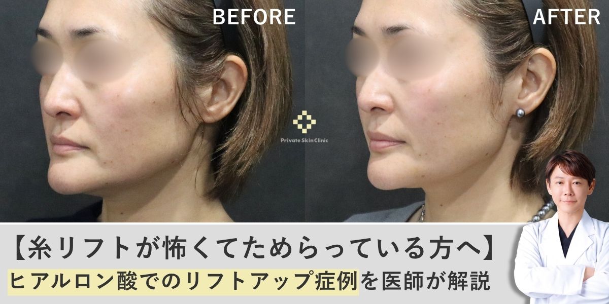 「糸リフトは怖いけど、たるみはどうにかしたい」そんな方へ。ヒアルロン酸リフトアップの症例を医師が解説