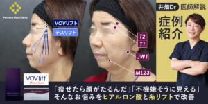 井畑医師解説！症例紹介コラム「痩せたら顔がたるんだ」「不機嫌そうに見える」そんなお悩みをヒアルロン酸と糸リフトで改善