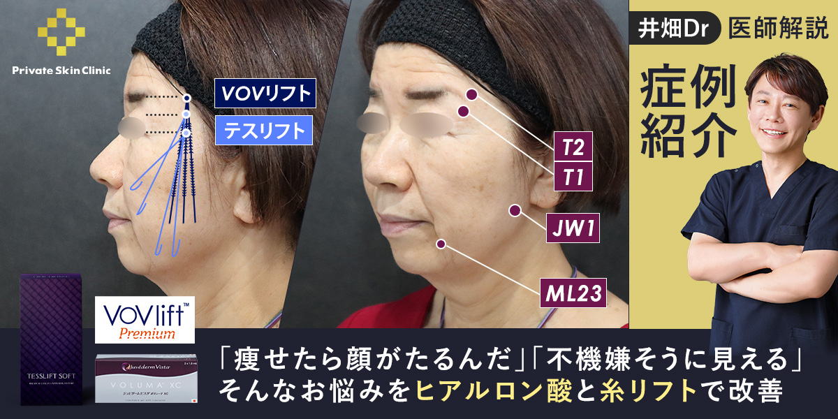 「痩せたら顔がたるんだ」「不機嫌そうに見える」そんなお悩みをヒアルロン酸と糸リフトで改善