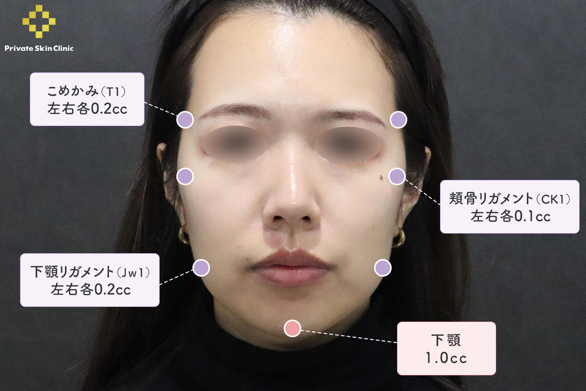 ヒアルロン酸ボリューマ2本注入箇所