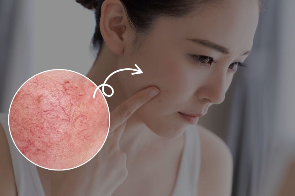 赤みで効果が出にくい人の特徴