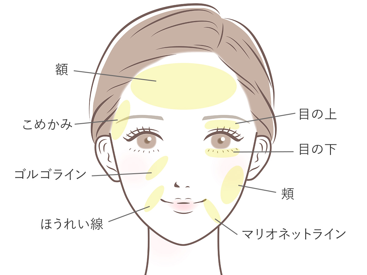 顔の脂肪注入の対象部位