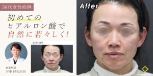 初めてのヒアルロン酸で自然に若々しく【50代女性の施術翔例解説】