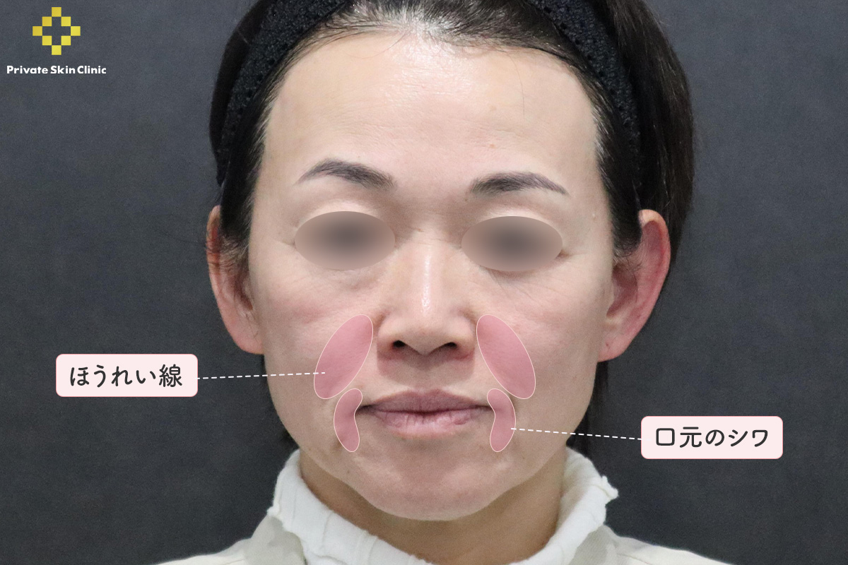 患者様が気にされている個所（ほうれい線・口元のシワ）