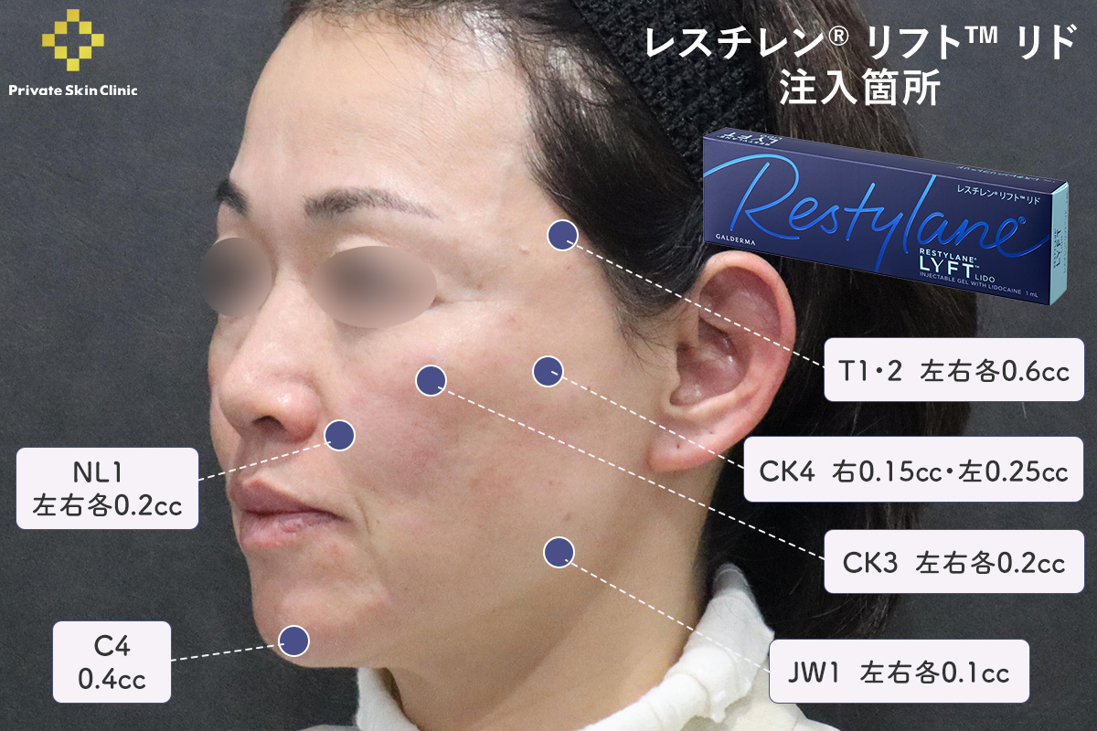 ヒアルロン酸注入箇所（レスチレン リフト リド3本）