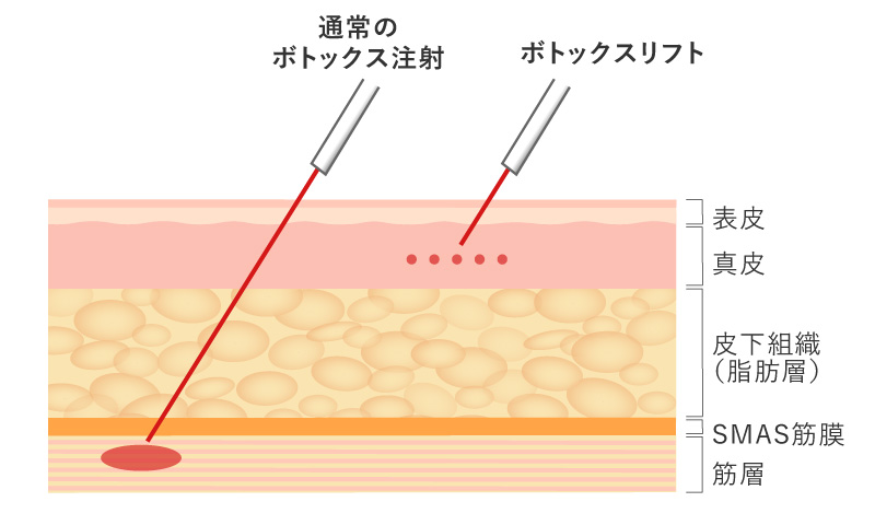 ボトックス注射（シワ）の注入レイヤー（層）