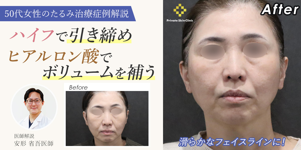 ハイフで引き締め、ヒアルロン酸でボリュームを補う｜50代のたるみ治療症例