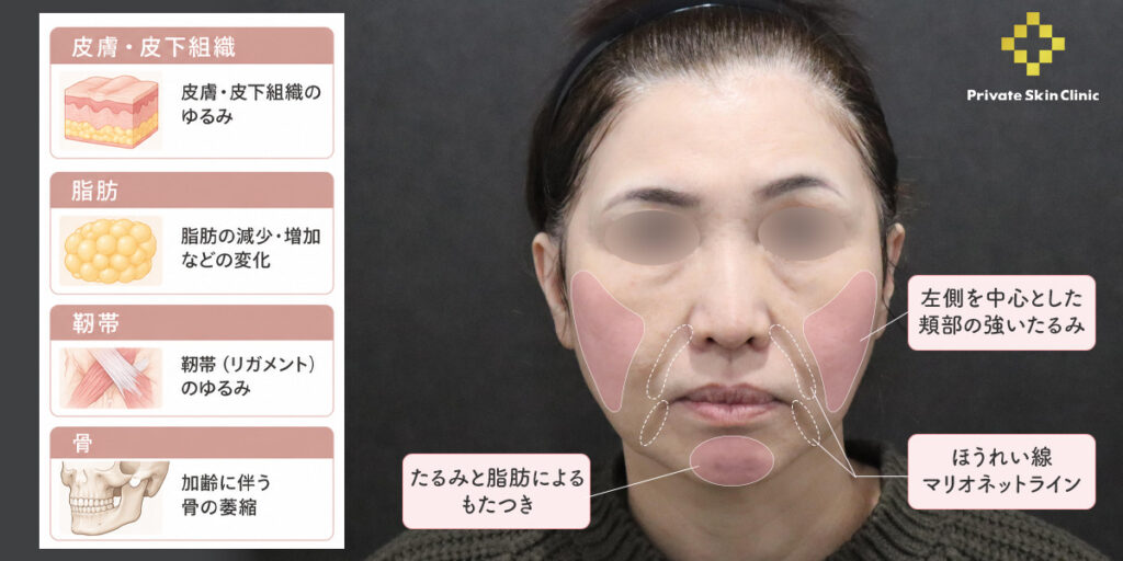 50代女性｜ハイフとヒアルロン酸を併用したたるみ治療症例