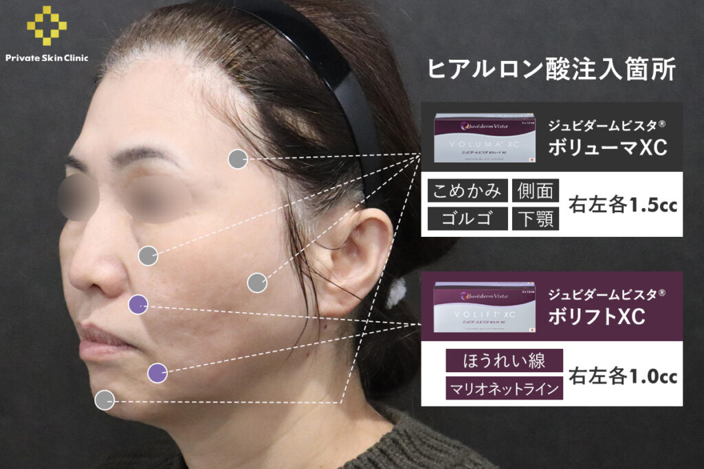 50代女性のヒアルロン酸注射の注入箇所