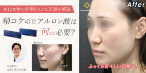 頬コケのヒアルロン酸は何cc必要？症例をもとに医師が解説