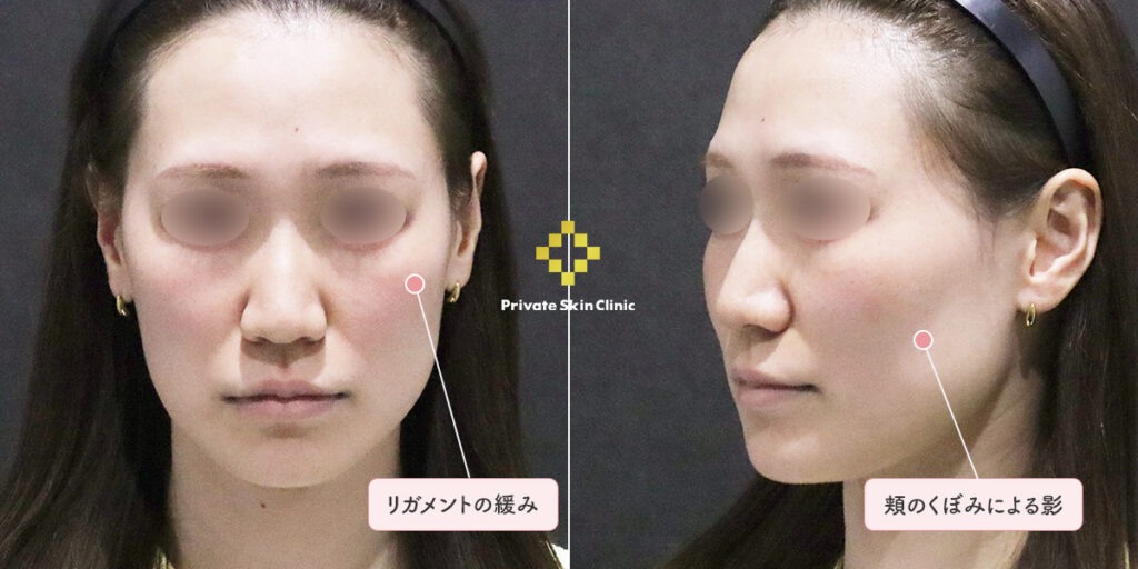 頬のくぼみによって影が目立つ30代女性