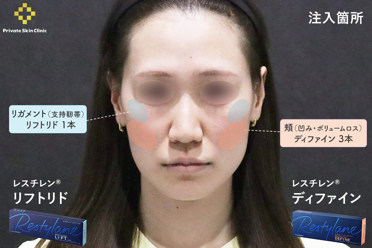 レスチレン®リフトリド・レスチレン®ディファインを使用