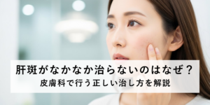 肝斑がなかなか治らないのはなぜ？皮膚科で行う正しい治し方を解説
