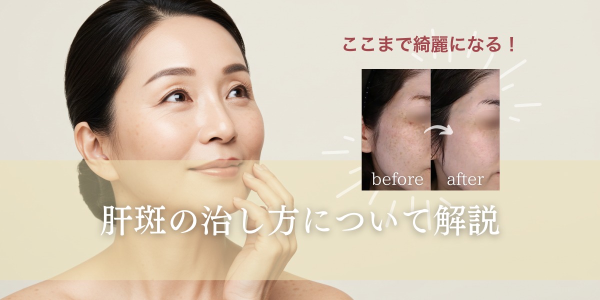 ここまで綺麗になる!肝斑の治し方を解説