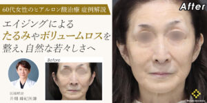【症例解説】60代女性のヒアルロン酸治療｜エイジングによるたるみやボリュームロスを整え、自然な若々しさへ