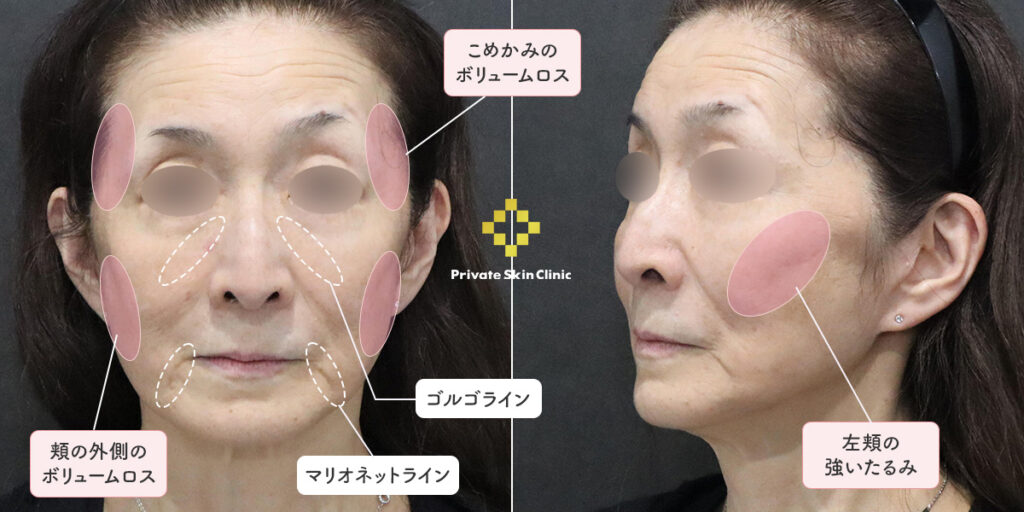 顔全体の輪郭を引き上げたいなどのお悩みをかかえた60代女性