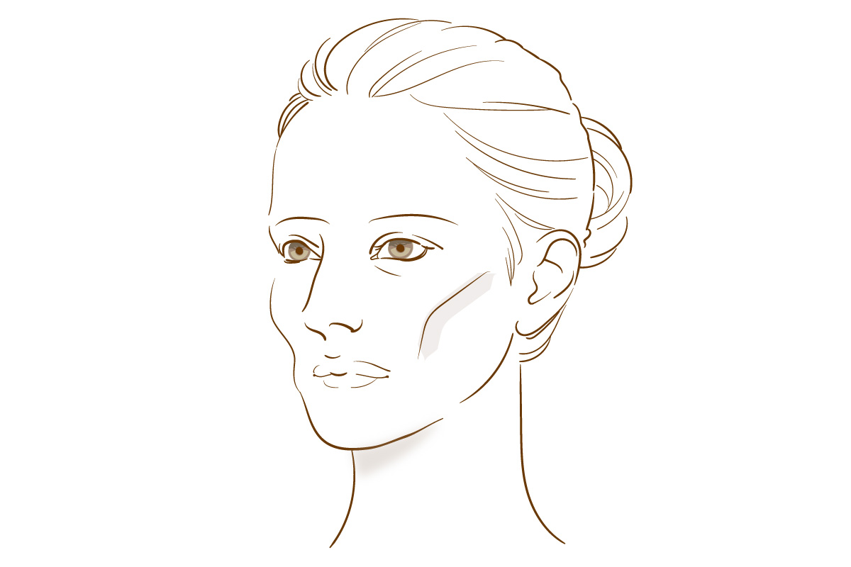 頬のヒアルロン酸注射 側面ボリューム減少タイプ