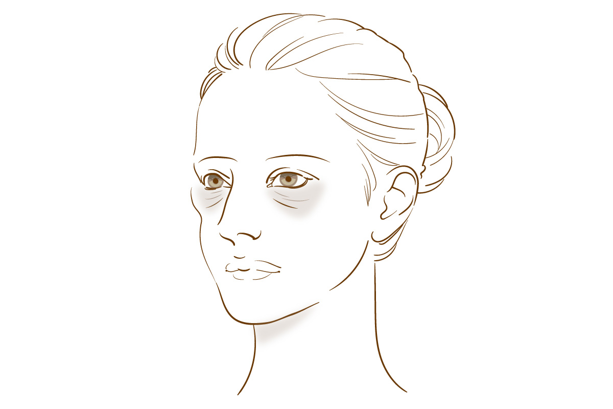 頬のヒアルロン酸注射 前面ボリューム減少タイプ