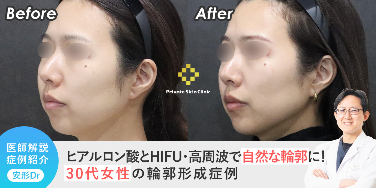 ヒアルロン酸とHIFU・高周波で叶える自然な輪郭形成【30代症例】