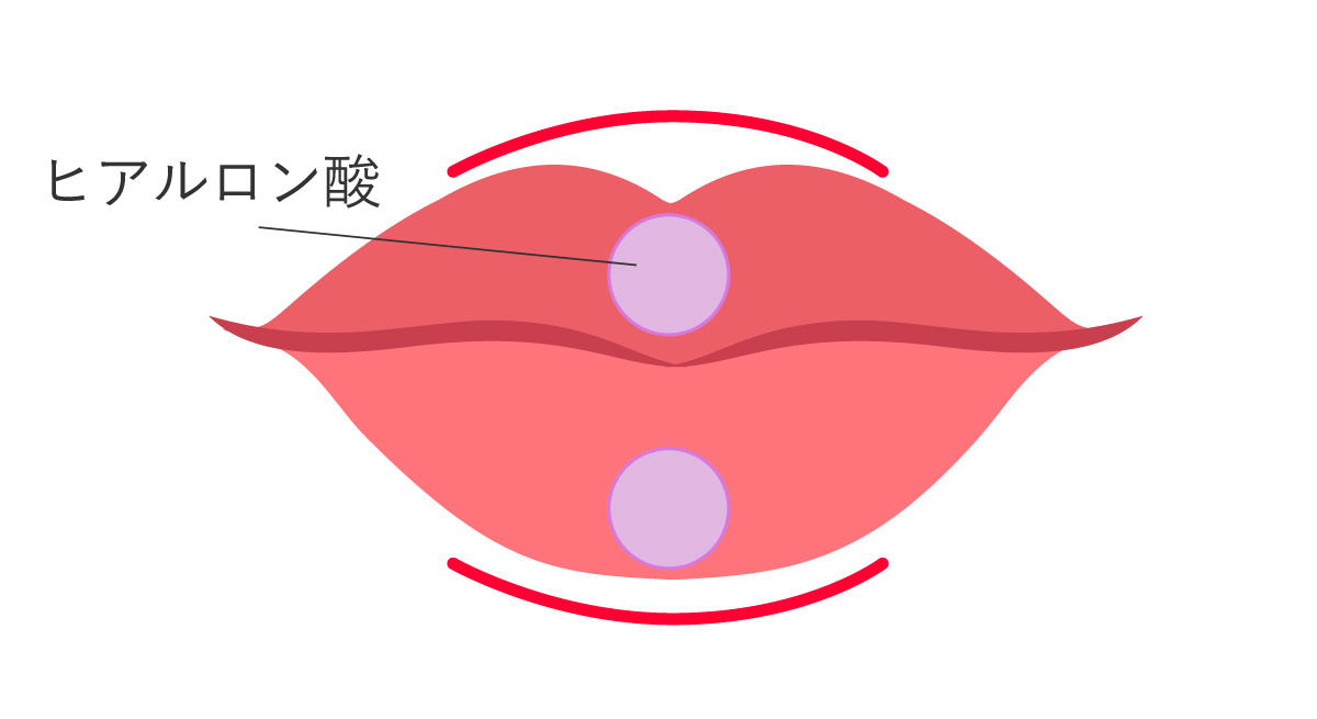 ヒアルロン酸注射（唇）アヒル口