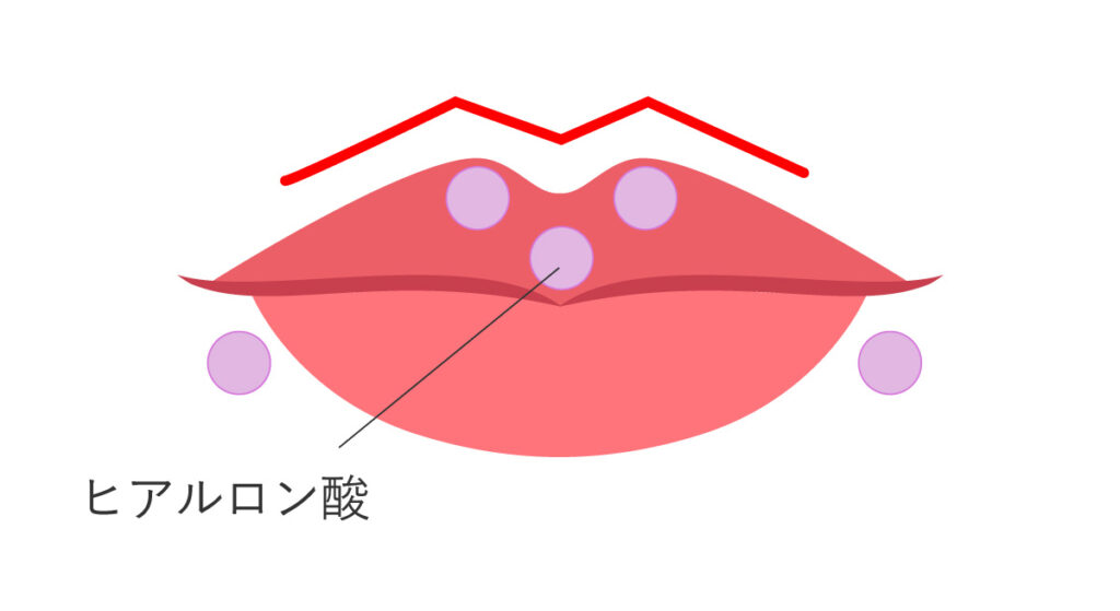 ヒアルロン酸注射（唇）M字リップ