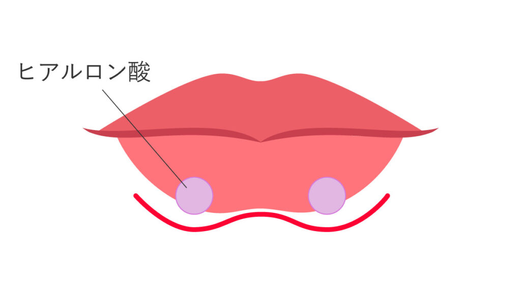 ヒアルロン酸注射（唇）ピーナッツリップ