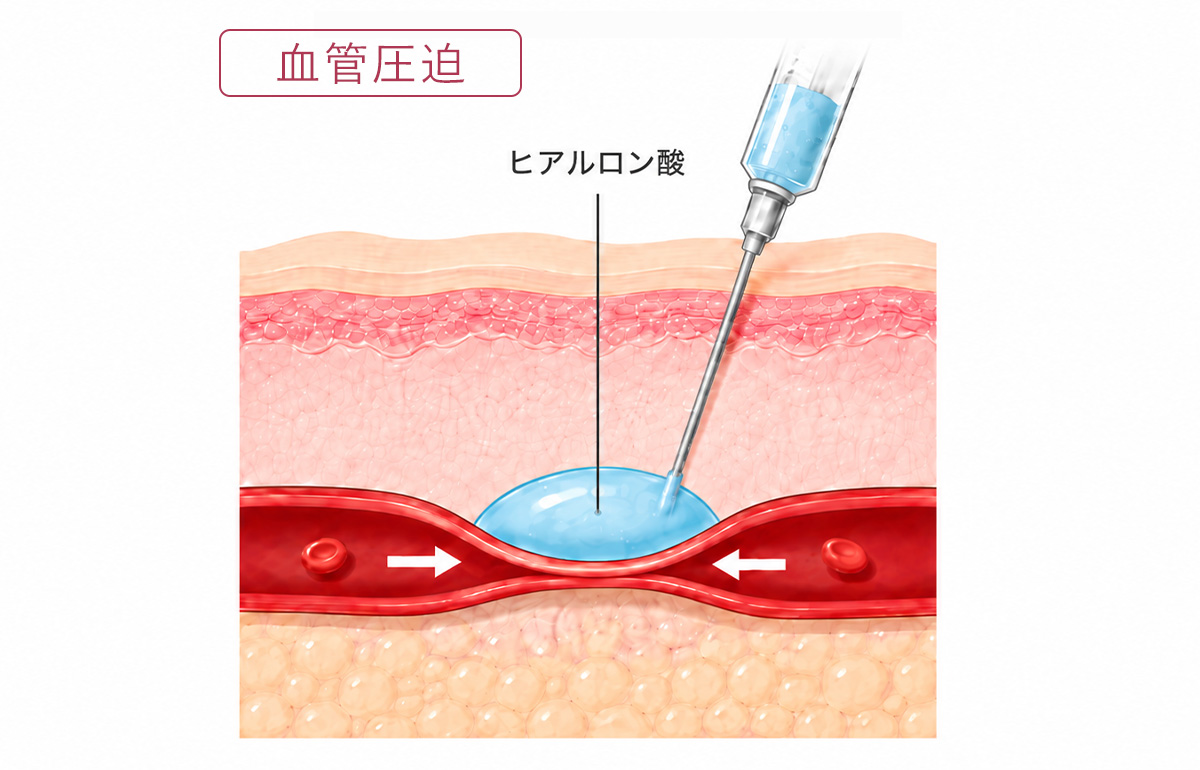 外側から血管が圧迫されて血行不全を引き起こす