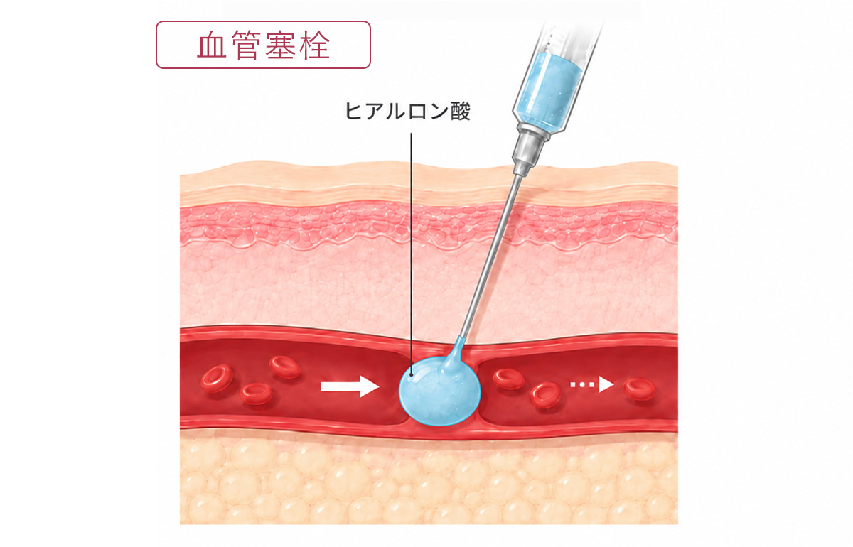 血管塞栓とは、ヒアルロン酸が血管に入り込み、血流を塞いでしまう状態