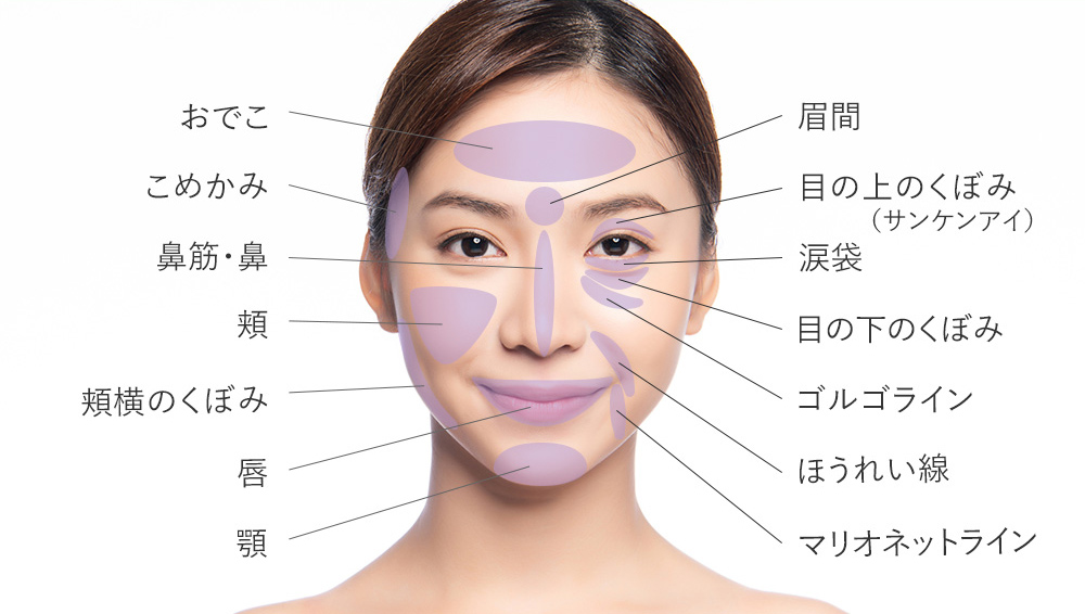 ヒアルロン酸注射の適応部位