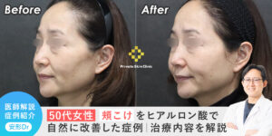 【50代女性】頬こけをヒアルロン酸で自然に改善した症例｜治療内容を解説