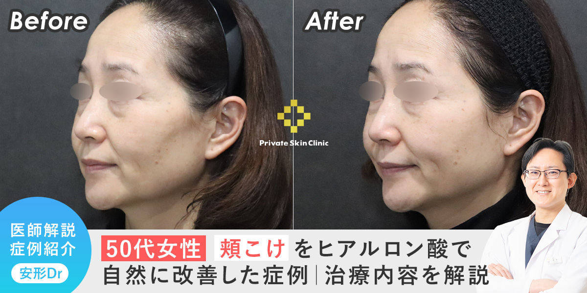【50代女性】頬こけをヒアルロン酸で自然に改善した症例|治療内容を解説