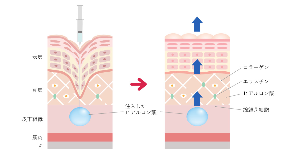 ヒアルロン酸の注入方法