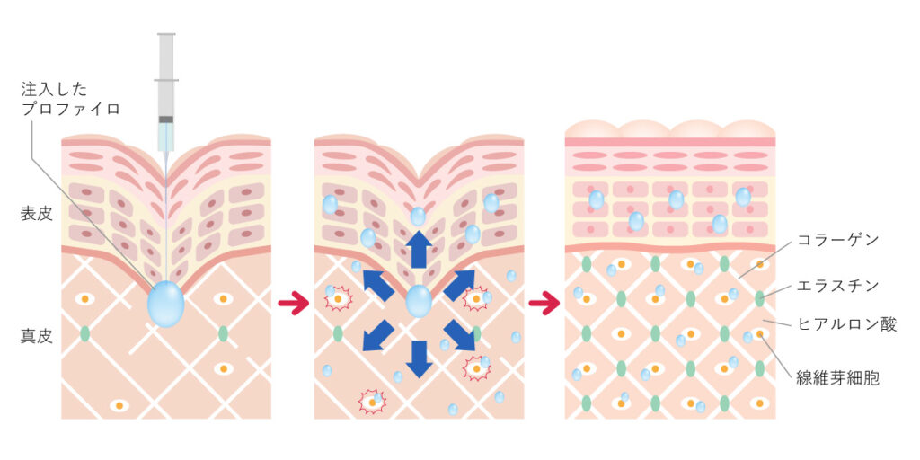 プロファイロの注入方法