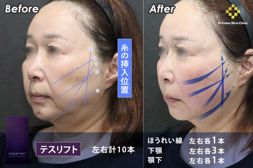 リフトアップ効果の高い「テスリフト」を10本使用し、ほうれい線に左右1本ずつ、下頬に左右3本ずつ、顎下に左右1本ずつ挿入