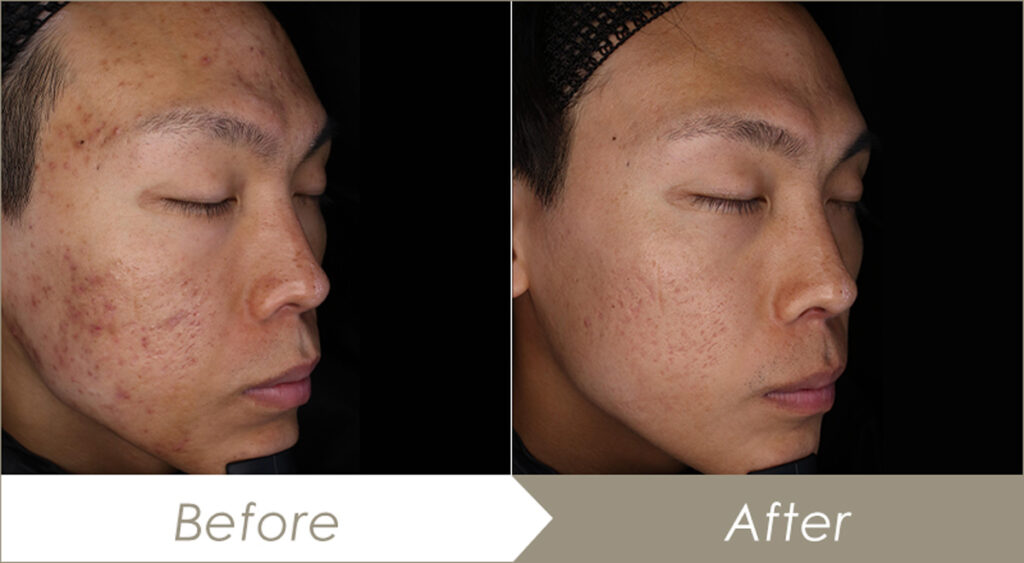 イソトレチノイン(ニキビ治療薬)の施術例