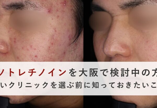 イソトレチノインは大阪で安く受けられる？価格差が出る理由を医師が解説