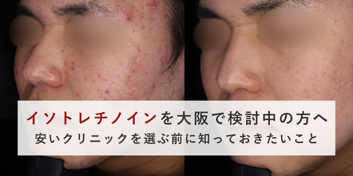 イソトレチノインは大阪で安く受けられる？価格差が出る理由を医師が解説