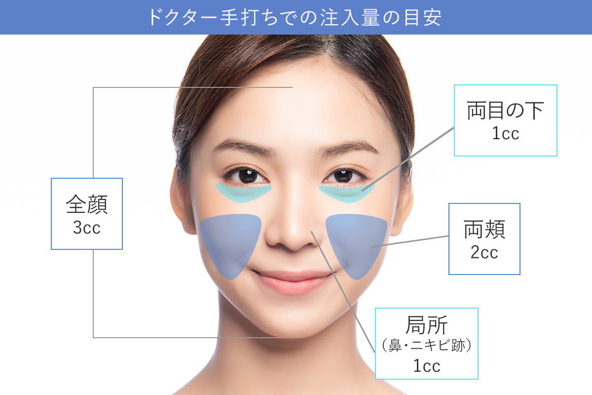 ジュベルック ドクター手打ちでの注入量の目安