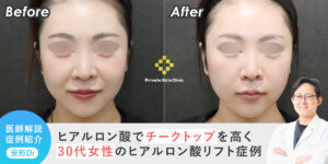 【症例紹介】ヒアルロン酸でチークトップを高く。30代女性のヒアルロン酸リフト症例