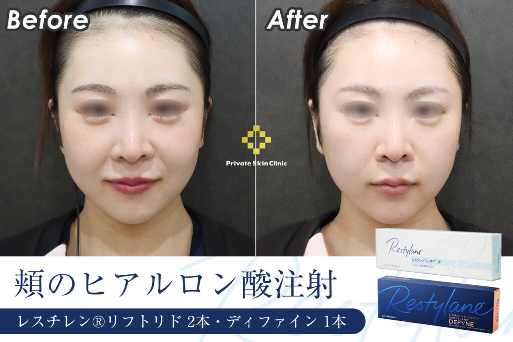 ヒアルロン酸でチークトップを高く。30代女性のヒアルロン酸リフト症例　ビフォーアフター（正面）