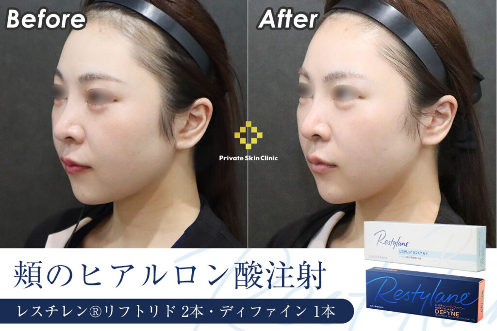 ヒアルロン酸でチークトップを高く。30代女性のヒアルロン酸リフト症例　ビフォーアフター（斜め）