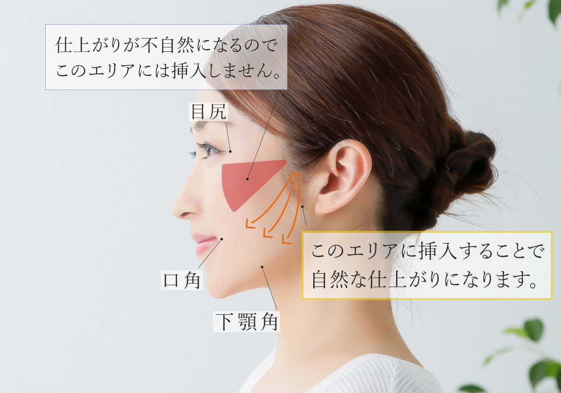 糸によるリフトアップ（スレッド）の治療範囲