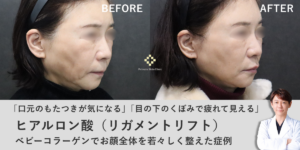 リガメントリフトとベビーコラーゲンでお顔全体を若々しく整えた症例