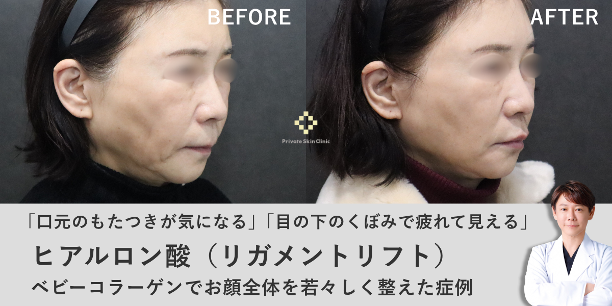 「口元のもたつきが気になる」「目の下のくぼみで疲れて見える」リガメントリフトとベビーコラーゲンでお顔全体を若々しく整えた症例