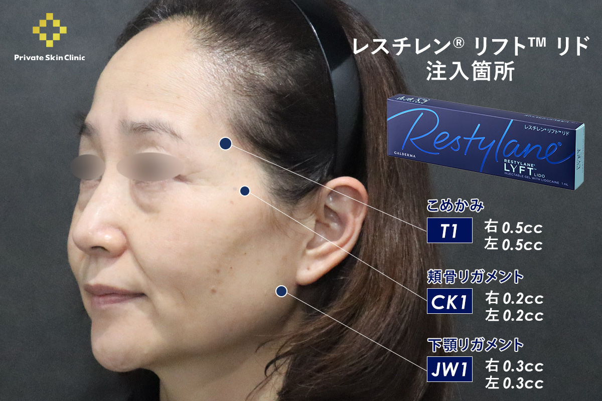 レスチレン® リフト™ リド　2本　こめかみ（T1）：左右各0.5cc・頬骨リガメント（CK1）：左右各0.2cc・下顎リガメント（Jw1）：左右各0.3cc