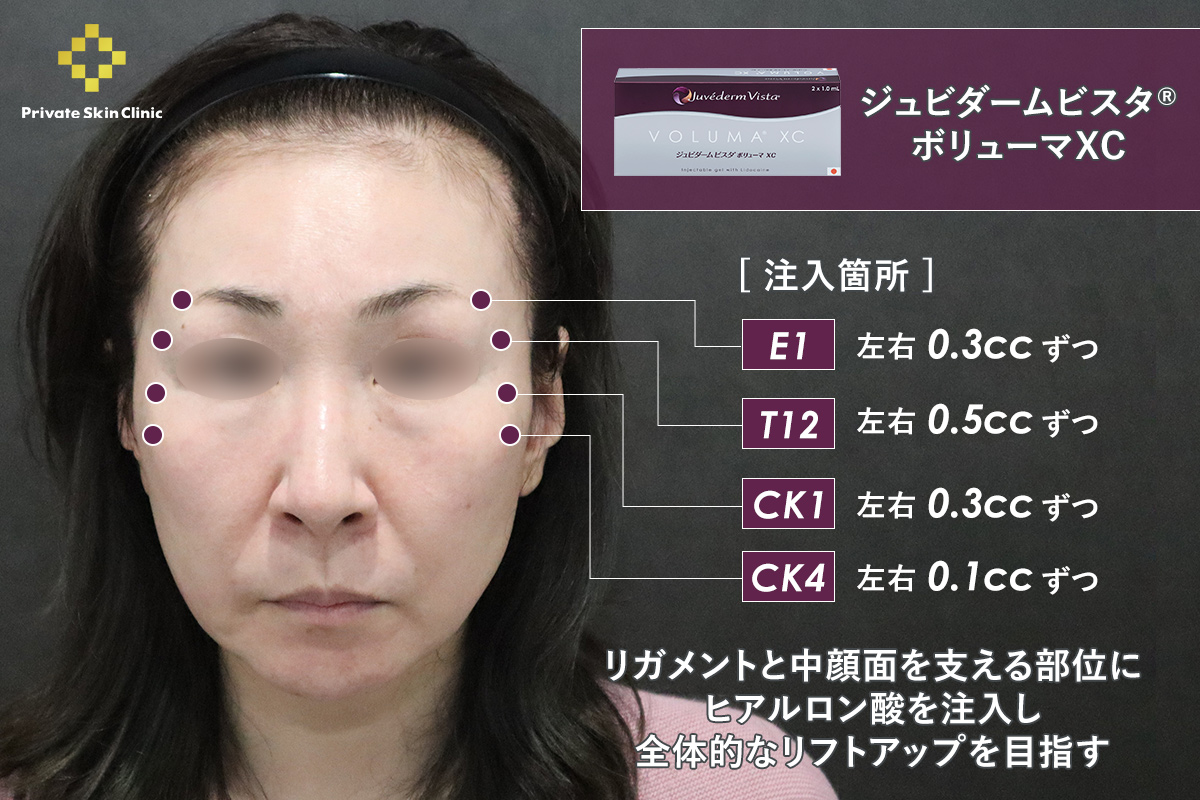リガメント周辺・中顔面｜ジュビダームビスタ® ボリューマXC
