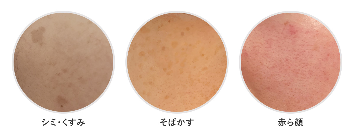 ルメッカの施術におすすめの肌のお悩み