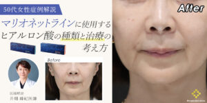 【症例解説】マリオネットラインに使用するヒアルロン酸の種類と治療の考え方
