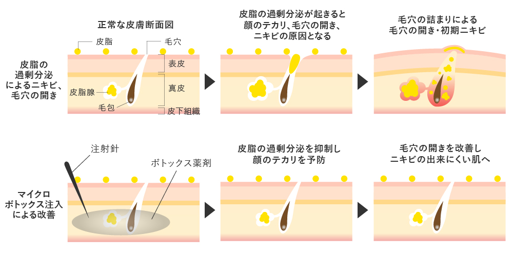 ボトックスを皮膚の浅い層に注入することによる白ニキビ・毛穴の開きに対する効果"
